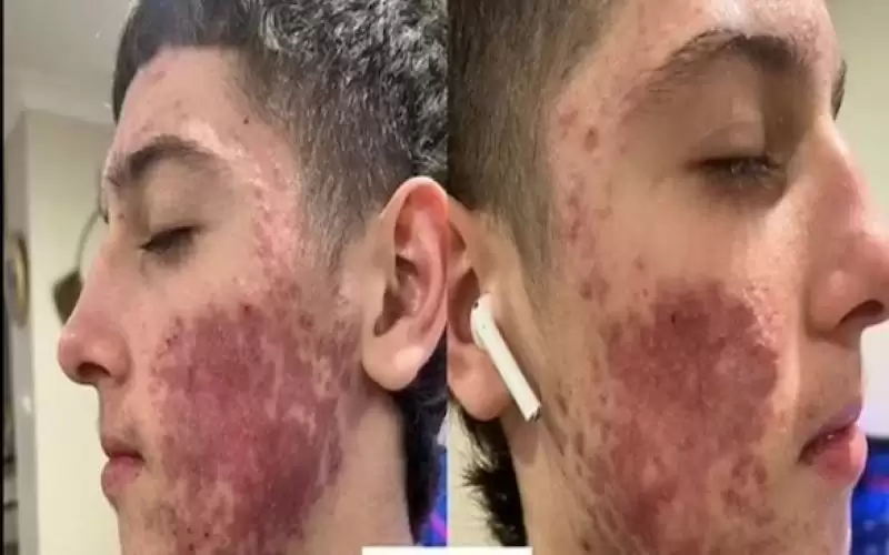 يتخلص من حساسية جلدية شديدة خلال