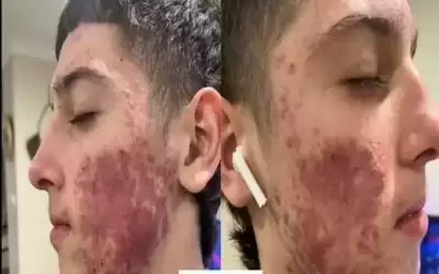 يتخلص من حساسية جلدية شديدة خلال