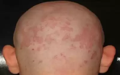 فطريات فروة الرأس.. .الأسباب والعلاج