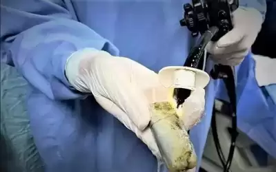 ظل في معدته أكثر من شهرين..