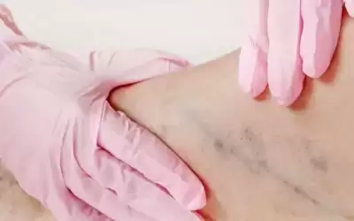 علامتان في الساق تنذران بحدوث جلطة
