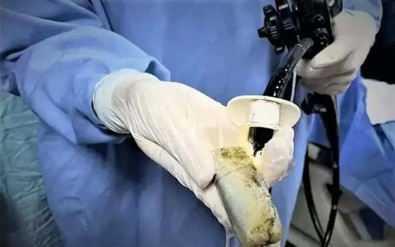 ظل في معدته أكثر من شهرين