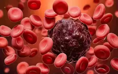 علاج رائد لنوع فتاك من سرطان