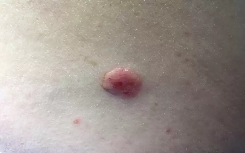 بسبب التعرض الطويل للشمس.. هذا هو