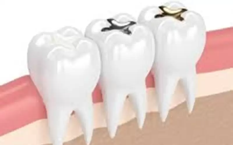 هل حشو الأسنان آمن أثناء الحمل؟