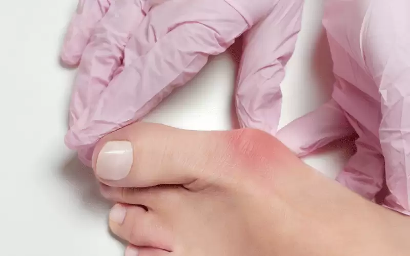 نتوء عظمي مؤلم.. ما لا تعرفه