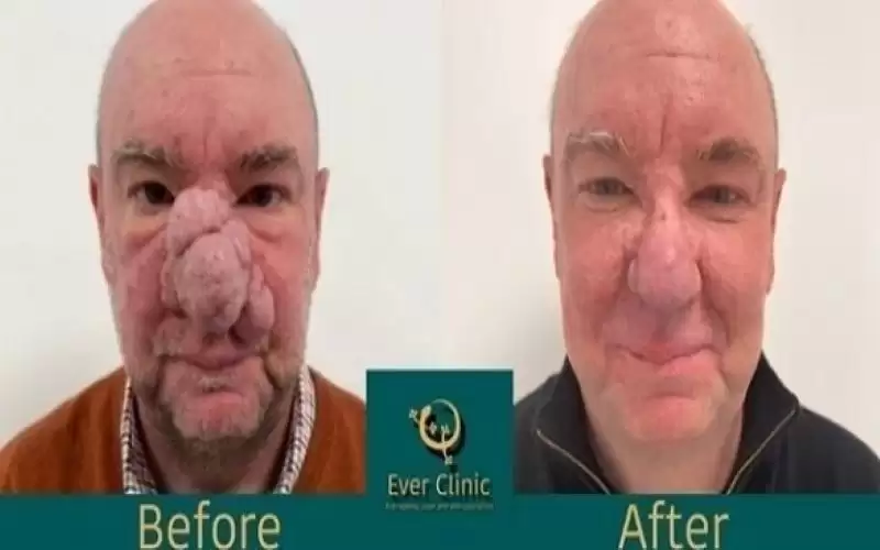 تخليص اسكتلندي من أنفه الضخم بالليزر