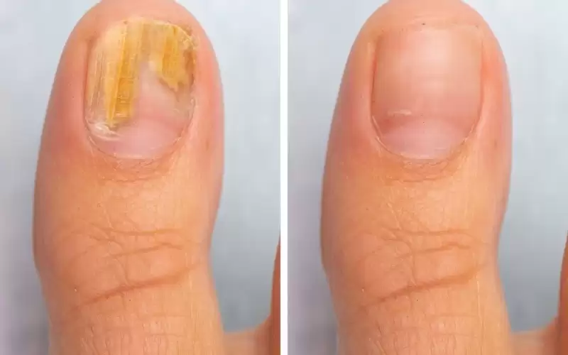 فطريات الأظافر تحتاج إلى علاج