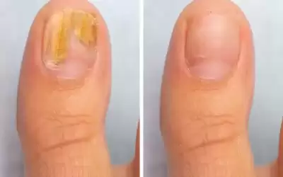 فطريات الأظافر تحتاج إلى علاج