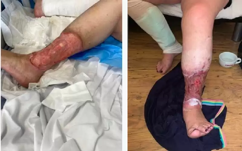 لدغة بعوضة كادت تبتر رجليها