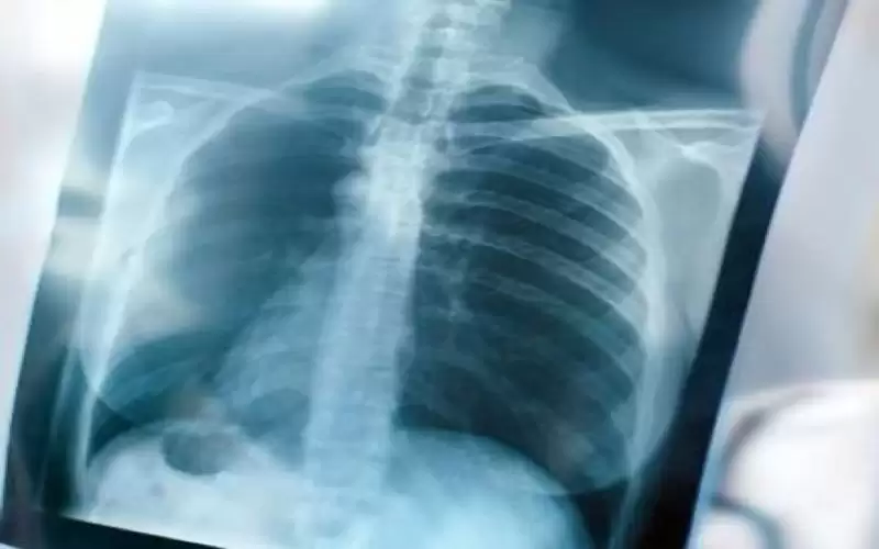 الالتهاب الرئوي البكتيري.. هؤلاء أكثر عرضة