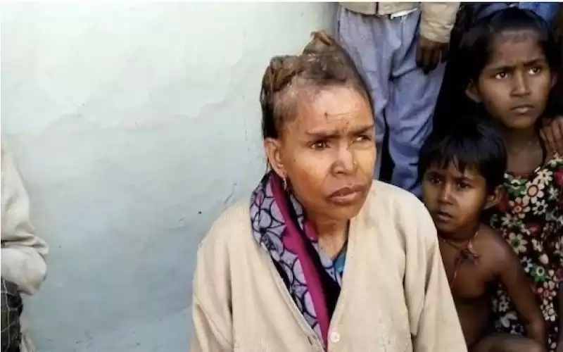 تحير الأطباء بـ قرون تنمو في