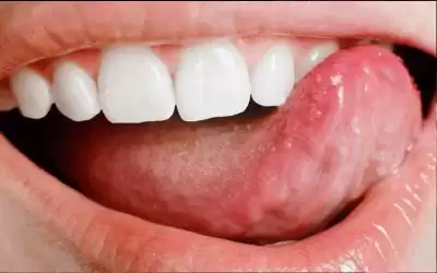 أبرز أسباب حبوب اللسان.. وهل تحتاج