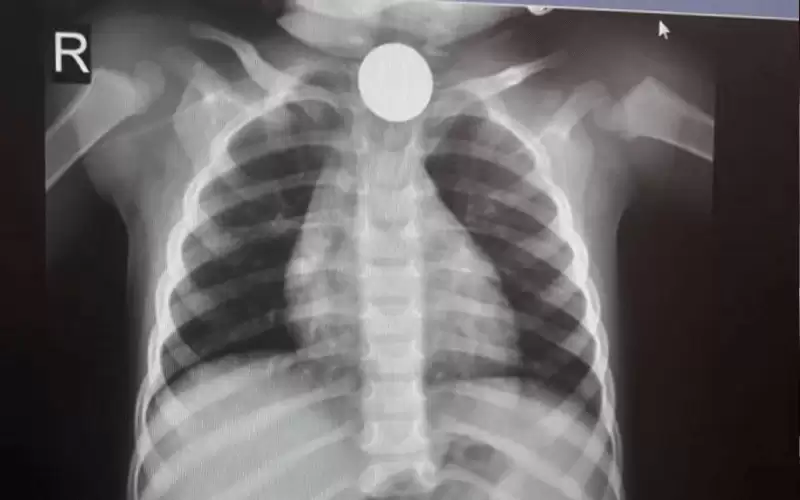 اسعاف طفل ابتلع بريزة في عمان