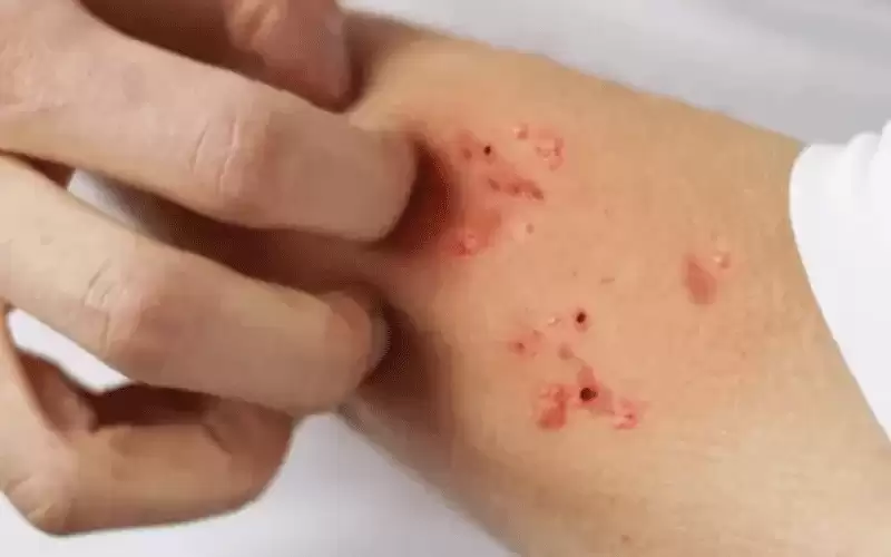 68 إصابة بالجرب في الأردن خلال