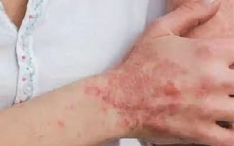 رصد إصابات بمرض جلدي نادر ببريطانيا