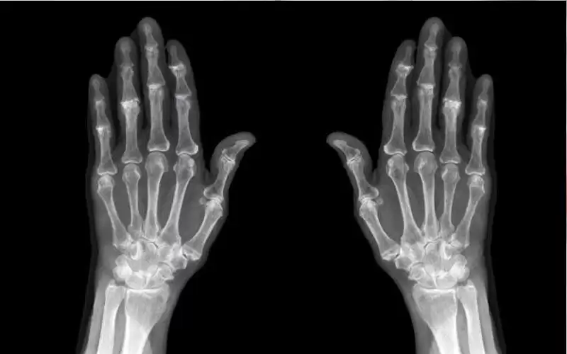 ما أسباب هشاشة العظام؟