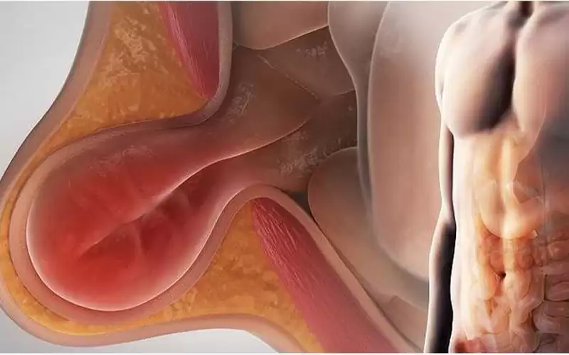 الفتق.. أنواعه وأعراضه وطرق جراحته