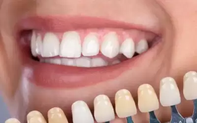 لون الأسنان.. . لماذا يتغير الى