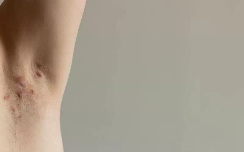 حقائق لا تعرفها عن التهاب الغدد