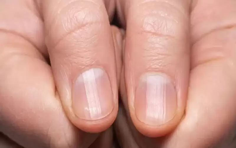 ما هي دلالة الخطوط على أظافرك؟