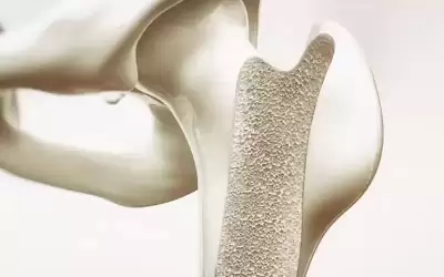 ‫التهاب العظام والنخاع.. الأسباب والأعراض والعلاج