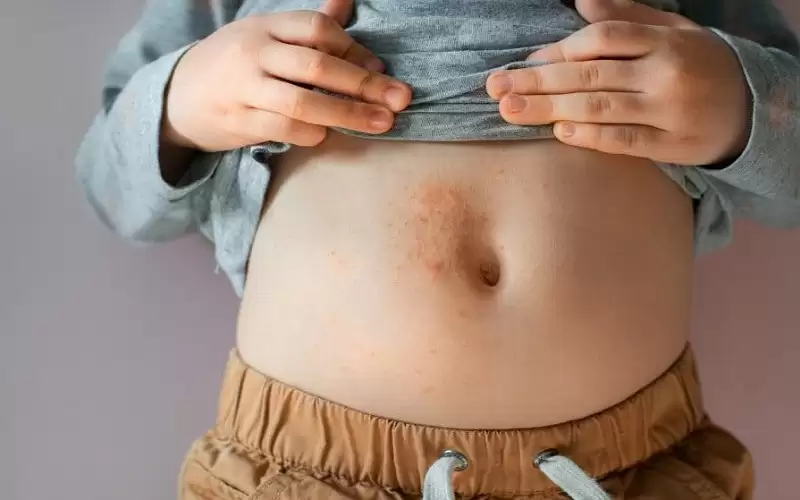 إدخال لقاح جدري الماء إلى برنامج