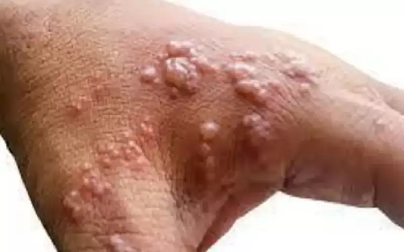 باكستان: ظهور أول حالة إصابة بجدري