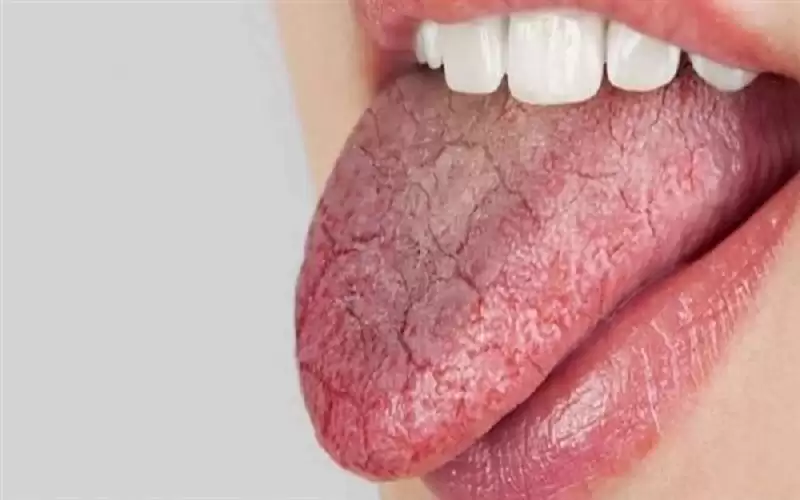 ارتفاع نسبة الإصابة بمرض بهجت في