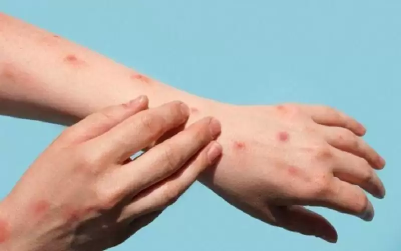 الصحة العالمية: جدري (إم بوكس) لم