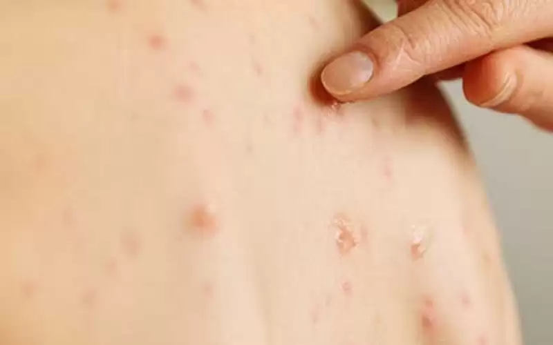 40 إصابة بأسبوع.. مخاوف من عودة