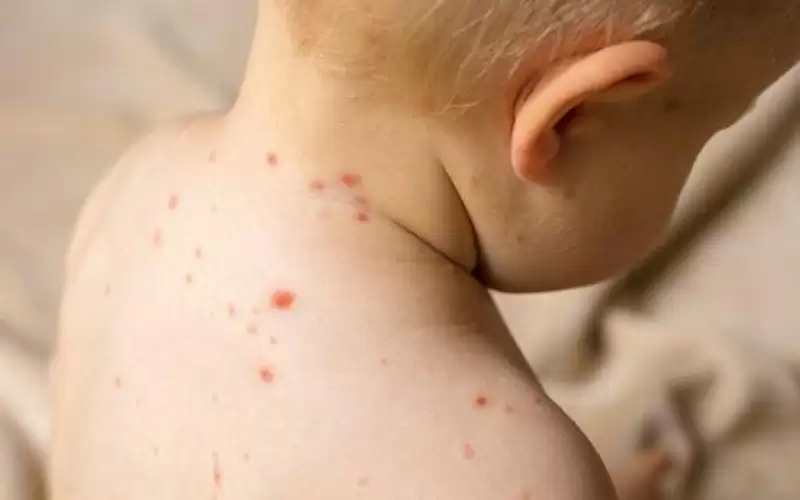 الصحة تحذر بعد تسجيل 27 إصابة