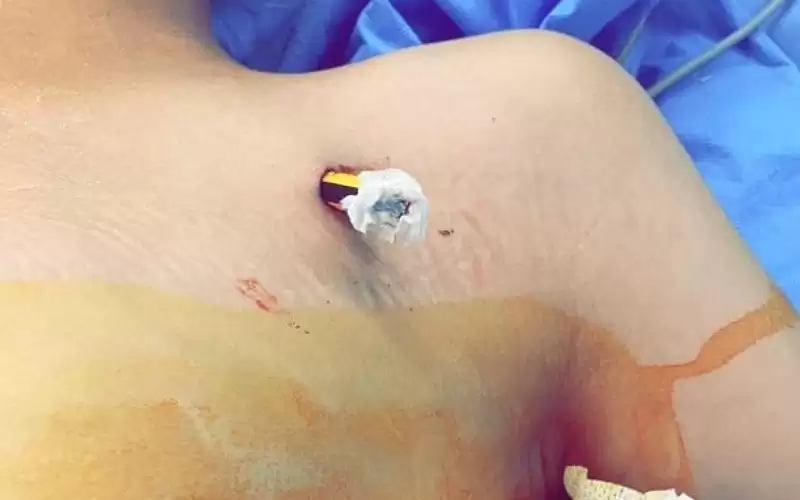 إنقاذ طفل من ( قلم رصاص)