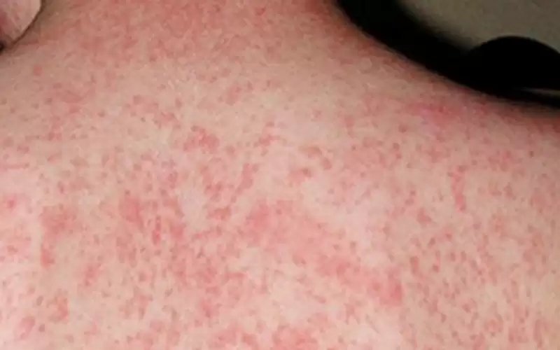 اشتباه بإصابة 10 أشخاص بالحصبة في