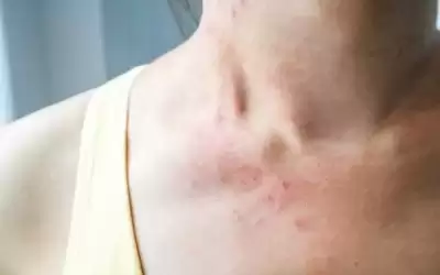 التهاب جلدي نادر.. تعرف على متلازمة