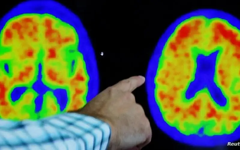 العلماء يشخصون أصغر مريض بالزهايمر على