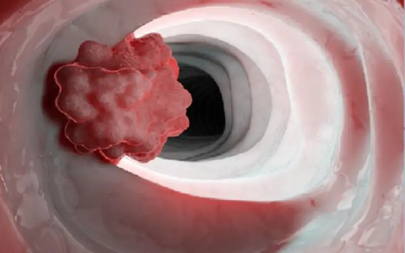 أخصائي أورام: الحرقة قد تشير إلى