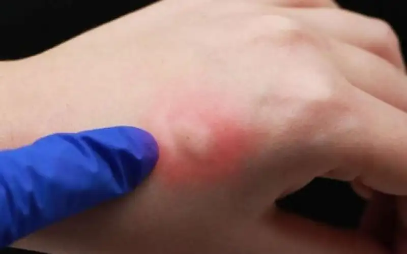 طبيب أردني يحذر من حساسية الحشرات