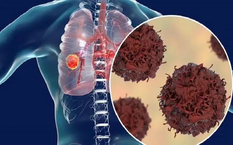 سرطان الرئة.. أعراض ظاهرة للعيان
