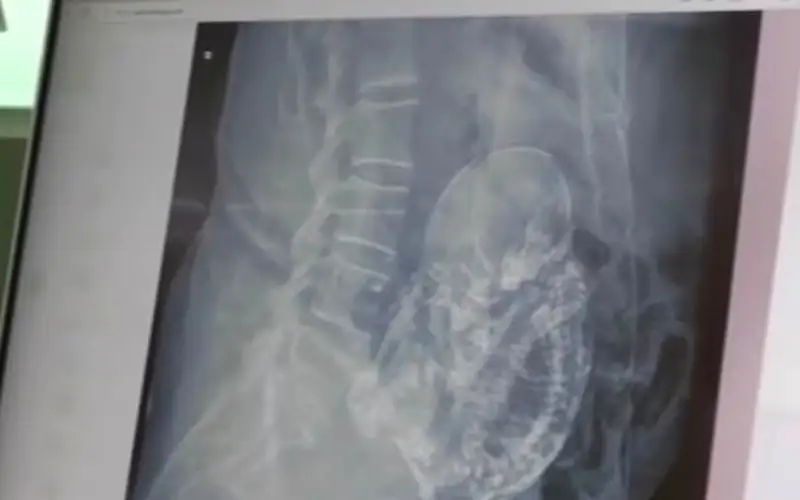 حدث نادر للغاية .. شعرت بآلام