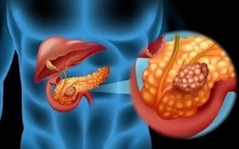 إنذار مبكر بسرطان البنكرياس