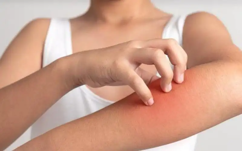 حساسية العرق المزعجة.. كيف تفلت منها؟