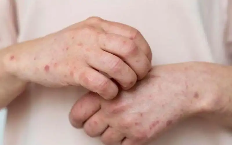 منشور خطير عن سرطان الجلد يجتاح