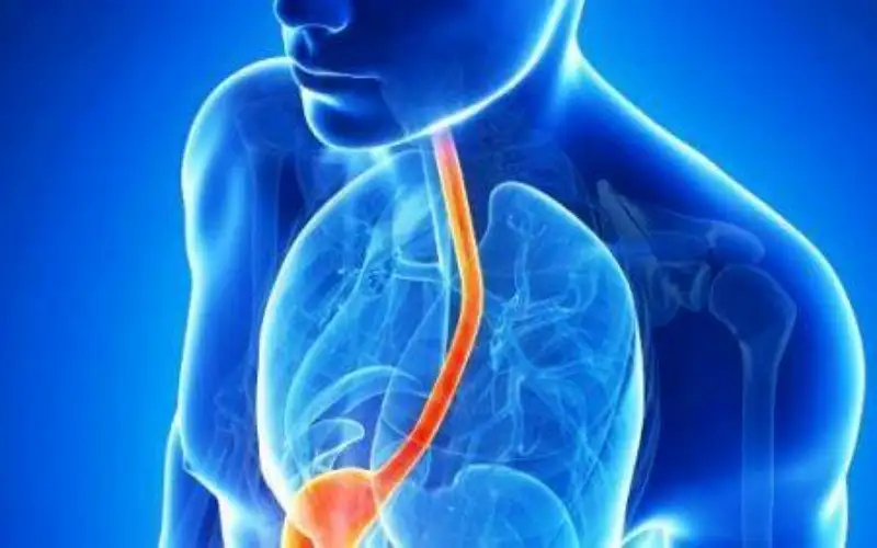 أعراض الإصابة بارتجاع المريء