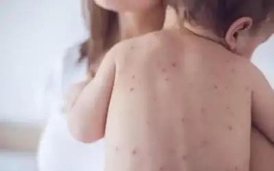 اليمن.. وفاة أكثر من 400 طفل