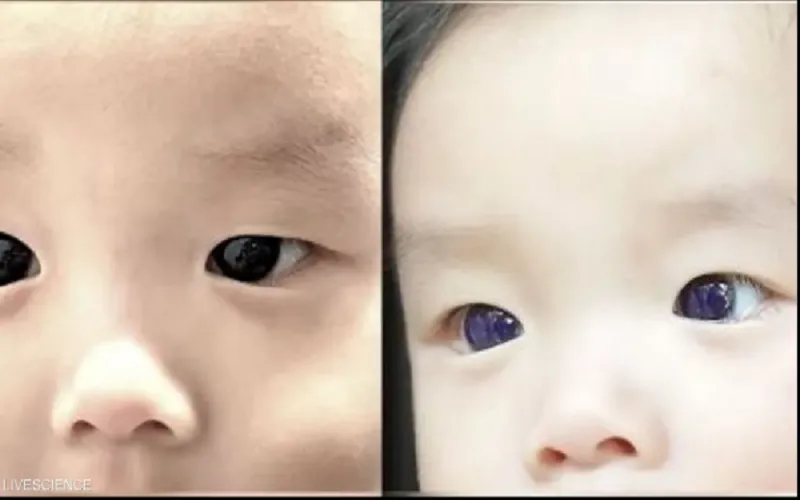 بسبب دواء لكوفيد 19 .. عينا