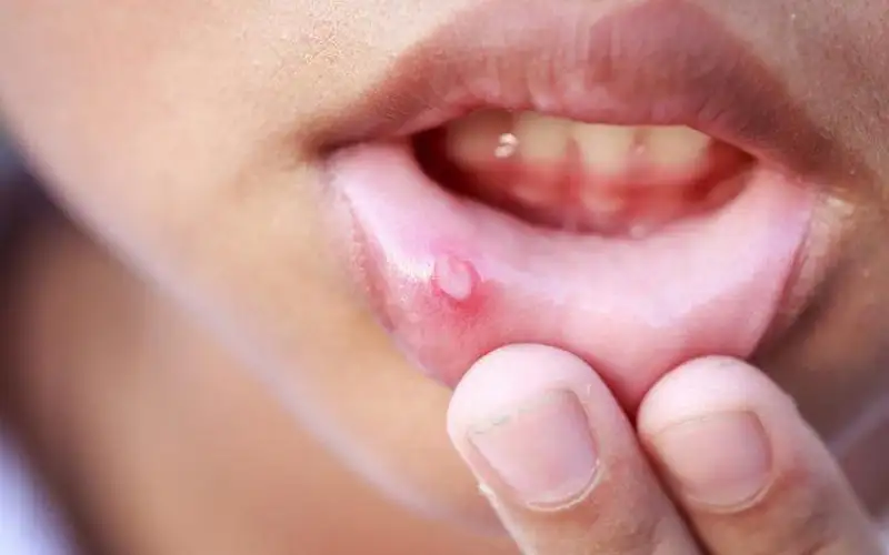 كيف تتخلص من تقرحات الفم