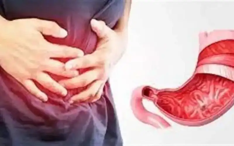 أطعمة ومشروبات تعالج قرحة المعدة