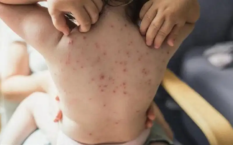 الصين تكافح جدري القردة بالإجراءات ضد