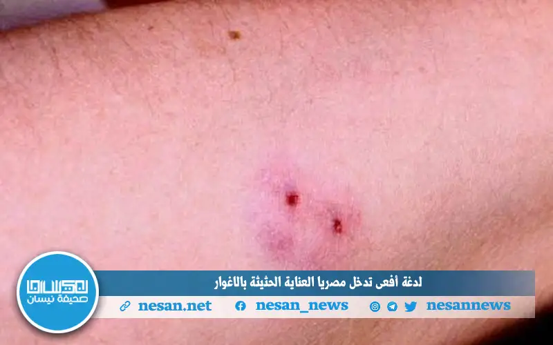 لدغة أفعى تدخل مصريا العناية الحثيثة